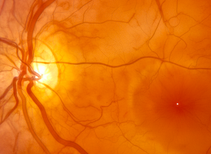 Macular Health